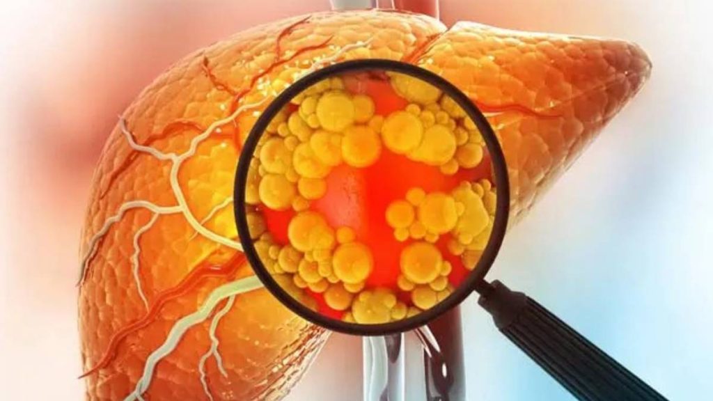 ‘Forever chemicals’ could increase liver disease risk in adolescents